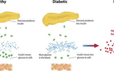 Diabetic Ketoacidosis