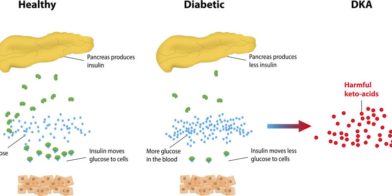 Diabetic Ketoacidosis